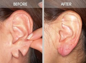 Ear-Lobe-Repair