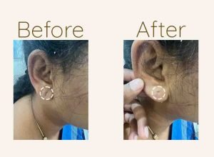 Ear-Lobe-Website-Icon-Before-and-After-2-1